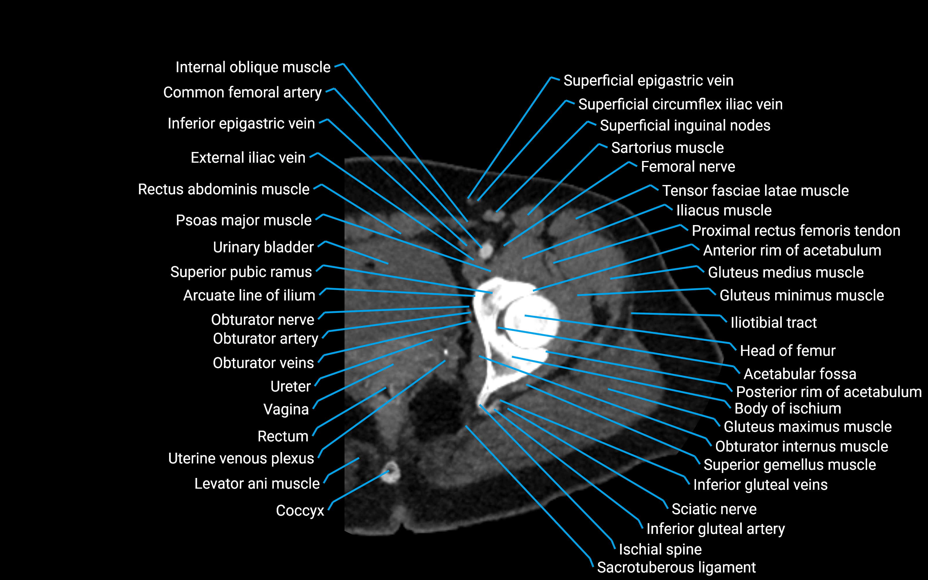 CT Hip axial cross sectional anatomy labelled image 5 (1).png